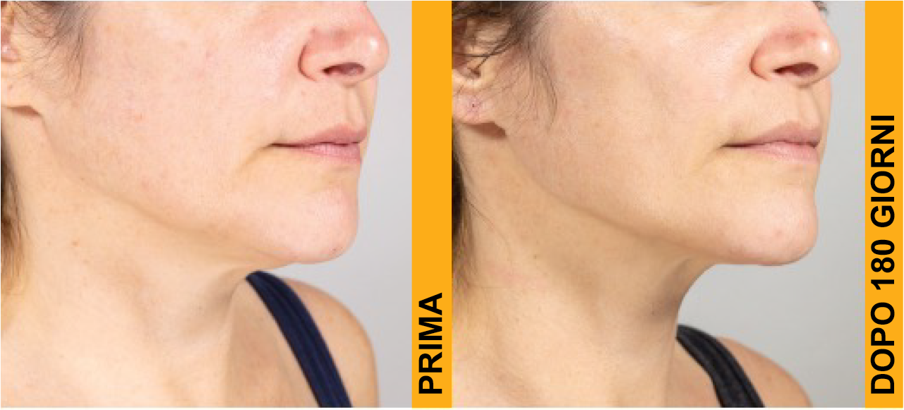 lifting non invasivo prima e dopo